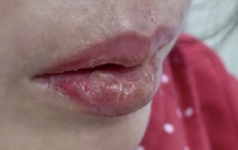 Dấu hiệu nhận biết khách hàng đã bị dị ứng mực xăm.1_Xambiz by letuyetnhi