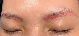 Lông mày bị trổ đỏ, nguyên nhân vì sao?.1_Xambiz by thuhaspa