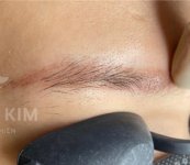 Các bước xử lý một ca lông mày phun bị trổ đỏ.1_Xambiz by diemmy