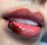 Tìm hiểu phương pháp hút dung dịch cho môi hỏng, không đều màu hoặc bết màu.1_Xambiz by tuuyen