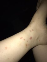 Em bị như trong hình, em nên dùng gì bôi ạ, rất ngứa xong còn để lại thâm ạ.1_Xambiz by lanhoang