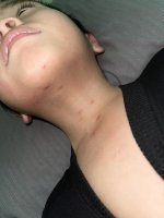 Con nhà e bị mụn như trong hình. Đi khám tuyến huyện thì họ bảo mụn cóc.1_Xambiz by thanhhang