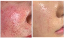 SO SÁNH SỰ KHÁC NHAU GIỮA BONG DA KHI DÙNG RETINOIDS VÀ DO THUỐC RƯỢU‼️.1_Xambiz by phamthilieu
