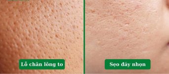 Đừng nhầm lẫn giữa lỗ chân long to và sẹo đáy nhọn ❌.1_Xambiz by phamthilieu