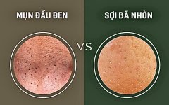 Nguyên nhân, biện pháp phòng tránh và cách điều trị mụn đầu đen.1_Xambiz by phamthilieu