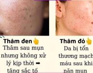PHÂN BIỆT THÂM ĐỎ, THÂM ĐEN & CÁCH XỬ LÝ CHÚNG❌.1_Xambiz by phamthilieu