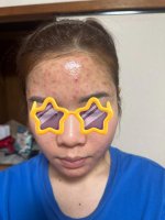 Da mình cứ bị mụn vùng trán liên miên, hết lớp này rồi lớp khác lại lên.1_Xambiz by phamthuylinh