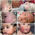 CÁCH CHỌN KEM DƯỠNG ẨM CHO NGƯỜI BỊ VIÊM DA CƠ ĐỊA.1_Xambiz by datcoca