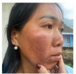 Người quen của em bị nám như thế này peel da có hết không ạ?.1_Xambiz by lanhoang