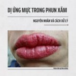 DỊ ỨNG MỰC TRONG PHUN XĂM.1_Xambiz by Quynh Huong PMU