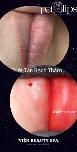 BÓC TÁCH LỚP SỪNG ĐỂ TRIỆT THÂM.1_Xambiz by MyVienNgo