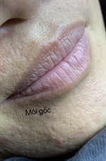 KHỬ THÂM KHÔNG KHÓ.1_Xambiz by Joliethanhhue