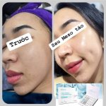 Công nghệ Meso Kim Tảo.1_Xambiz by trangbibi