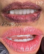 ĐIỀU TRỊ TĂNG SẮC TỐ MÔI.1_Xambiz by MyVienNgo