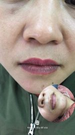 Cho em hỏi nguyên nhân và cách xử lý chiếc môi này.1_Xambiz by mailyngo