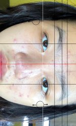 Khách bị tình trạng mắt lệch, bên này cao hơn bên kia.1_Xambiz by ngochan