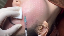 Những vấn đề mà bạn nên quan tâm khi muốn tiêm meso.1_Xambiz by luudung