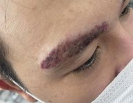 Lông mày như thế này bao lâu thì làm lại được?.1_Xambiz by diemmy