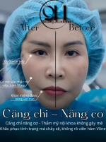 CĂNG DA MẶT KHÔNG PHẨU THUẬT.1_Xambiz by Quynh Huong PMU