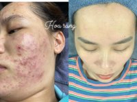 Điều trị da là cả một quá trình, không phải là ngày một ngày hai.1_Xambiz by hoasang